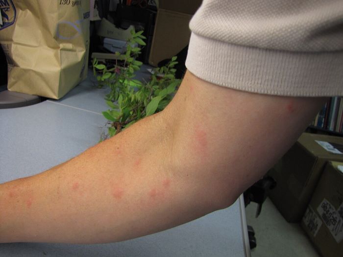 A dozen of mosquito bites on a man's arm. Africa's deadliest animal.